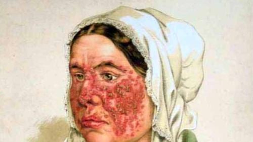 Un nou tratament promiţător pentru lupus ar putea duce la vindecarea bolii