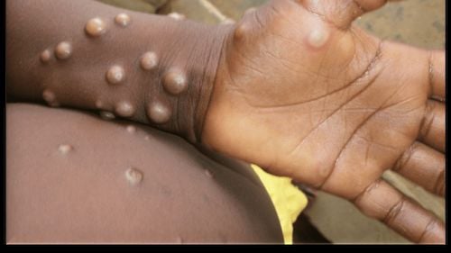 Variola maimuței: șeful Oganizației Mondiale a Sănătății îi sfătuiește pe homosexuali să își reducă numărul de parteneri