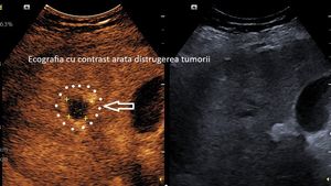 Spitalul Județean Craiova anunţă realizarea primei ablaţii cu microunde a unei tumori hepatice / La o lună după intervenţie s-a confirmat distrugerea completă a tumorii