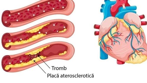 Medici: Această descoperire este unică prin faptul că am găsit o cale complet nouă către ateroscleroză / Unele persoane cu niveluri normale de grăsime în sânge dezvoltă boli de inimă la o vârstă fragedă. Oamenii de ştiinţă au o posibilă explicaţie