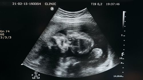 STUDIU Particule toxice prezente în aerul poluat, descoperite în premieră în plămânii şi creierul bebeluşilor nenăscuţi