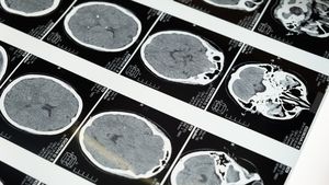Un pacient bolnav de Parkinson și-a recăpătat mirosul și poate face din nou sport după ce, în premieră mondială, i s-au implantat în creier 7 milioane de celule crescute în laborator