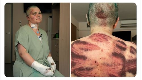 Ziarista Elena Milashina, după atacul brutal din Cecenia: Traumatism cranian, multiple fracturi la mâini