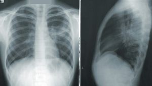 Tuberculoza, prima cauză de mortalitate infecţioasă la nivel mondial: A ucis 1,23 milioane de persoane în 2024 (OMS)