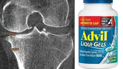 Administrarea de Ibuprofen pentru genunchii artritici dureroși determină agravarea afecțiunii, sugerează o cercetare din Statele Unite (The Times)