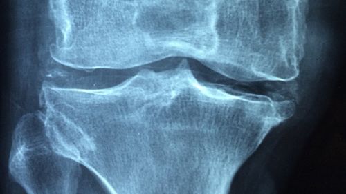 STUDIU: Osteoporoza, tratată cu un gel injectabil în oase / Ar crește densitatea osoasă de până la 4,8 ori într-o singură lună / 40% dintre femeile cu vârsta de peste 50 de ani suferă cel puțin o fractură osteoporotică majoră